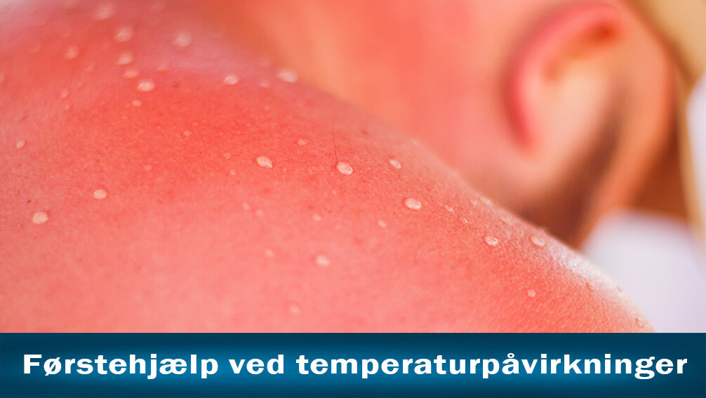 temperatur brandskade